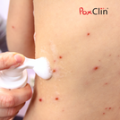 PoxClin® Varicelle