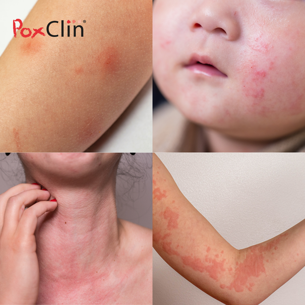 PoxClin® Démangeaisons