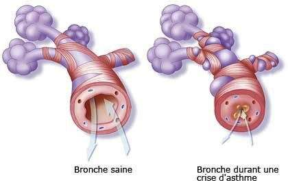 asthme de l'enfant