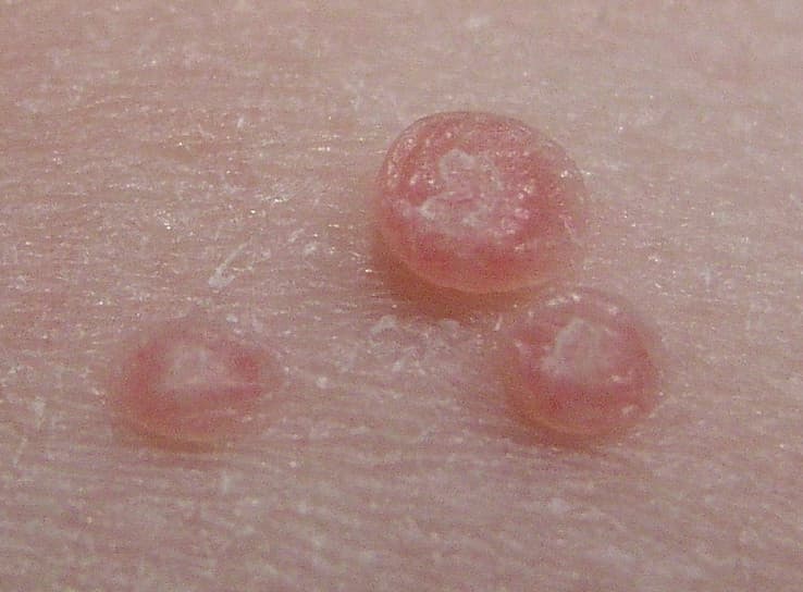 Pediact-molluscum-contagiosum-exemple